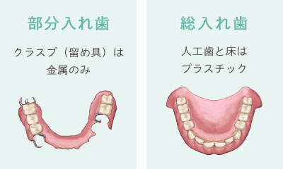 部分入れ歯（クラスプ（留め具）は金属のみ）　総入れ歯（人工歯と床はプラスチック）