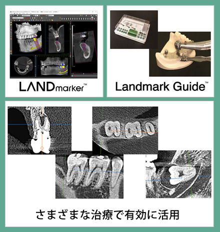 アイキャット社　インプラント手術支援システム「Landmark System」