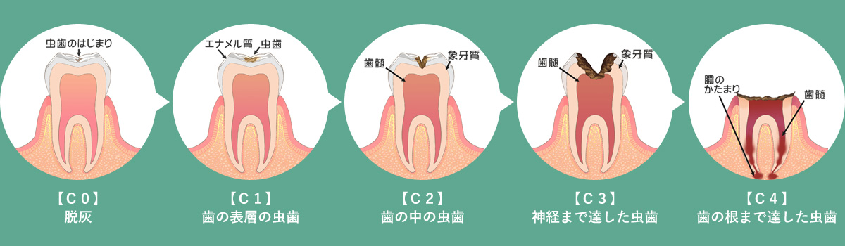 板橋区　虫歯の進行